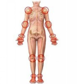Los ligares probables del surgimiento de la artrosis