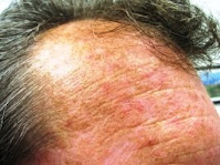 ganjapan,baldness skin diseases