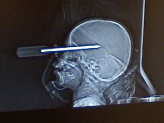 Minn. Child Sticks Screwdriver Into Head, Survives