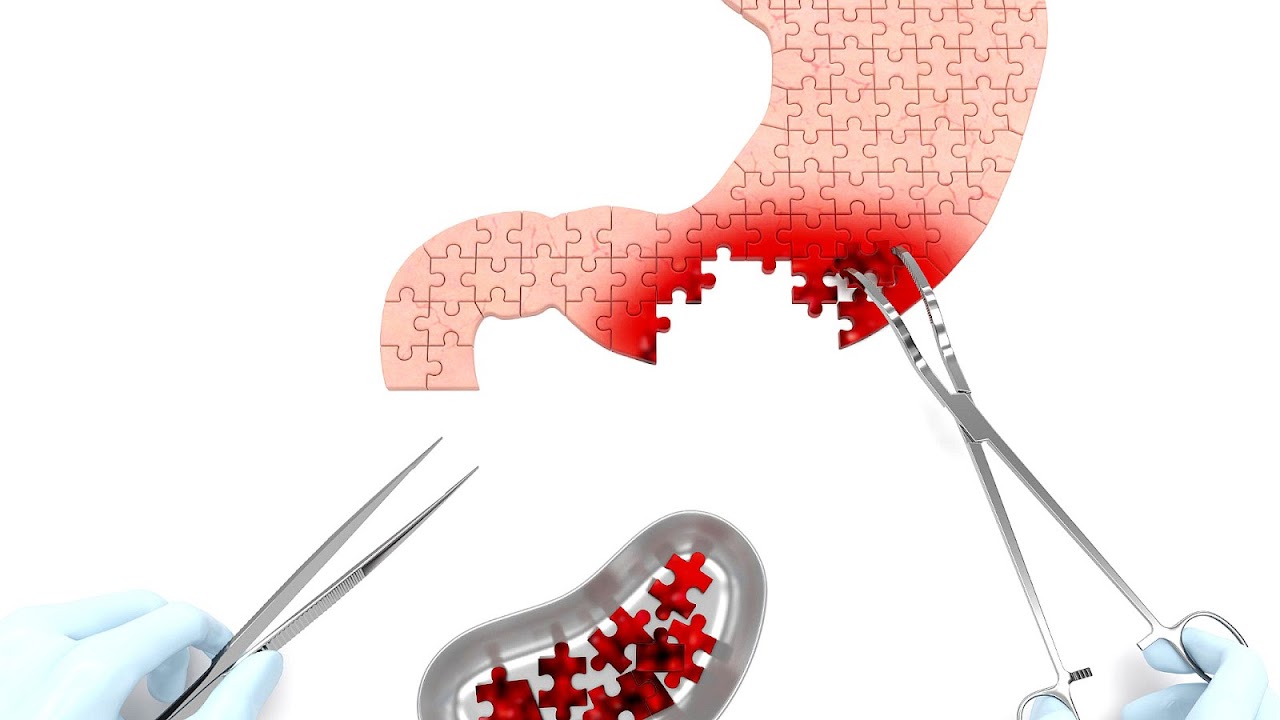 Stomach Ulcer Cancer Symptoms
