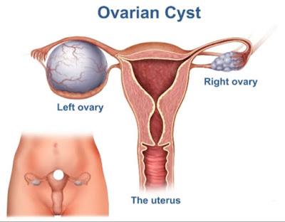 Cyst ovari