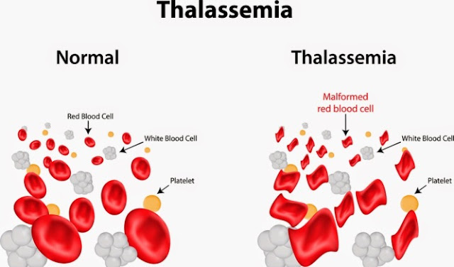 Penyakit Thalasemia, Penyebab, Dan Cara Mengatasinya
