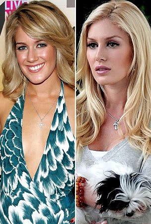 heidi montag before and after. heidi montag plastic surgery