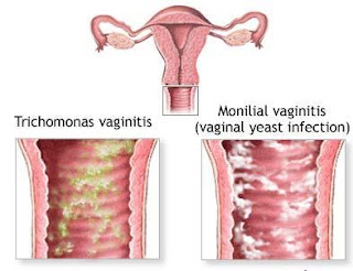 cara menyembuhkan keputihan pada wanita