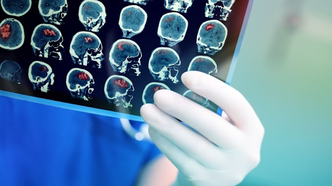 Stage 4 Brain Cancer: Causes, Symptoms, and Cure