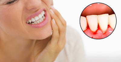 Chảy máu chân răng cách nào điều trị hay nhất? 1