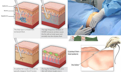 giảm béo cấp tốc