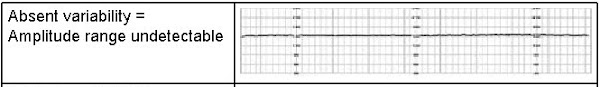 Absent Fetal Heart Rate Monitoring Strip