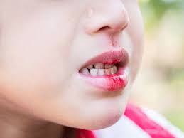 Nguyên nhân trẻ bị sưng lợi chảy máu chân răng 