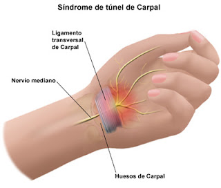 imagen de una mano resaltando la zona de la muñeca, donde se ubica el túnel carpiano