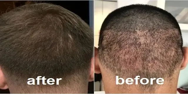 عملية زراعة الشعر قبل وبعد: دليل شامل فوائد وأعراض وكيفية الاجراء وتكلفة
