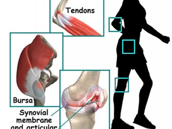 Ikhtiar Rawatan Alternatif Penyakit Rheumatoid Arthritis