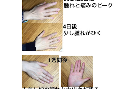 画像をダウンロード 突き指 テーピング 小指 第二関節 521920-突き指 テーピング 小指 第二関節