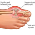 Sypmtoms Of Uric Acid In The Joints Of The Fooot