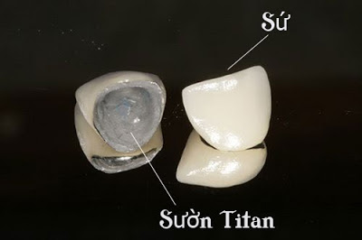 Các trường hợp nên bọc răng sứ titan