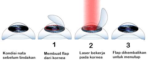 Mengenal Operasi LASIK Mata