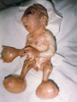 Baby Photo Effects on An Iraqi Baby Deformed By Radiation