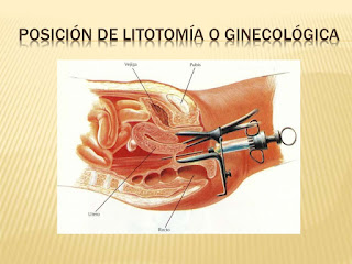   culdocentesis, culdocentesis positive result, culdocentesis definicion, culdocentesis non-clotting blood, culdocentesis procedure, culdocentesis procedure video, culdocentesis pronunciation, posterior colpotomy, angiography prep