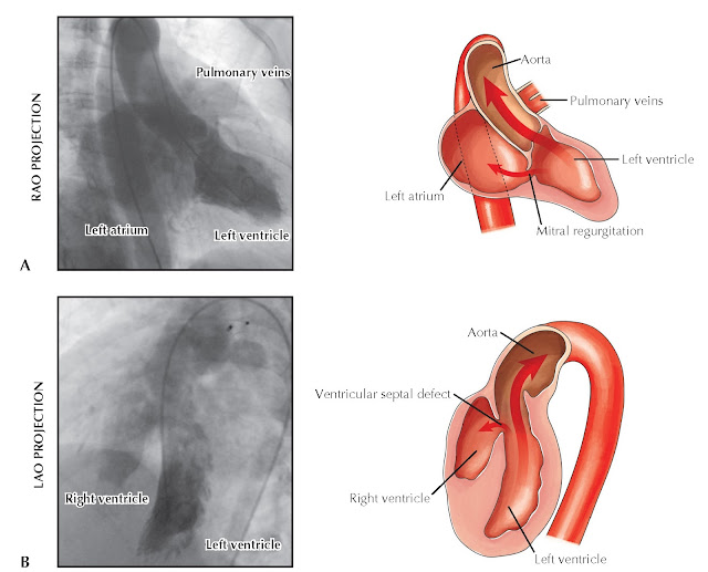 (A) Contrast injection into the left ventricle in a patient with severe mitral regurgitation (right anterior oblique [RAO] projection; note opacification of the left atrium and pulmonary veins). (B) Contrast injection into the left ventricle in a patient with a ventricular septal defect (left anterior oblique projection [LAO]; note that the right ventricle is opacified).