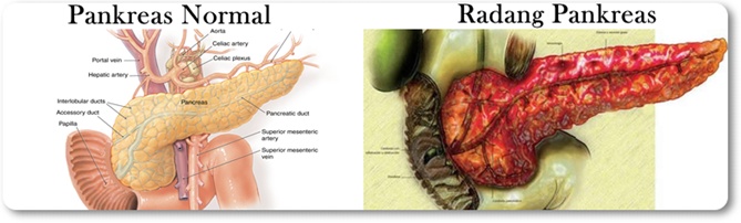 Obat Radang Pankreas Herbal