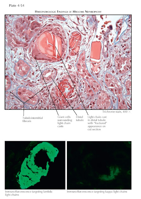 MYELOMA NEPHROPATHY