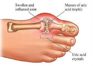 http://healthy-lifestyle20.blogspot.com/2016/02/natural-ways-to-treat-gout.html