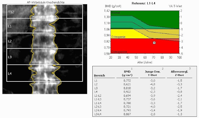 Auswertung einer DXA-Messung an der LWS bei Osteoporose