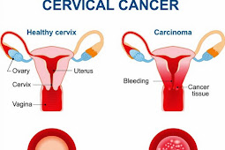 Symptoms Of Early Stage Cervical Cancer