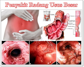 cara alami menyembuhkan radang usus besar