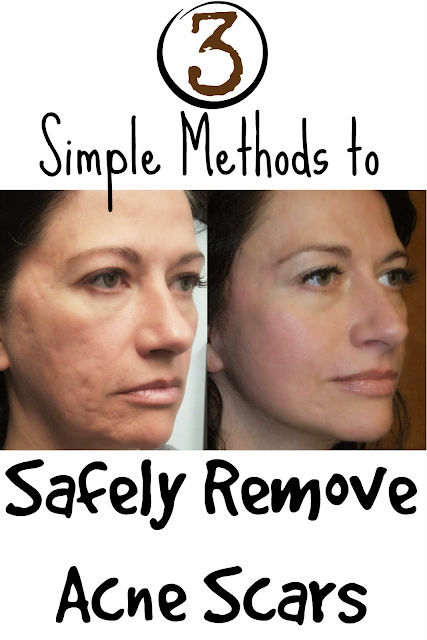 3 Simple Methods to Safely Remove Acne Scars