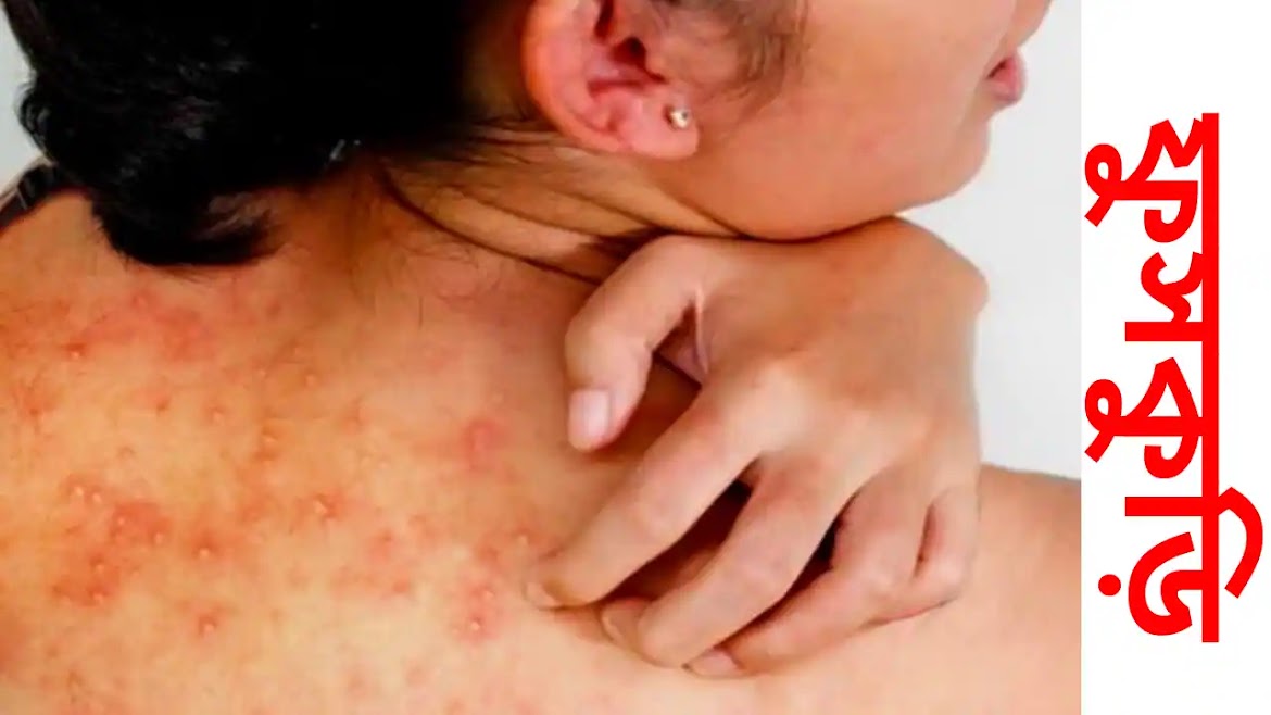 Skin Rashes Treatment: ফুসকুড়ি দূর করার উপায়, হওয়ার কারণ, লক্ষণ ও তার ঘরোয়া প্রতিকার।