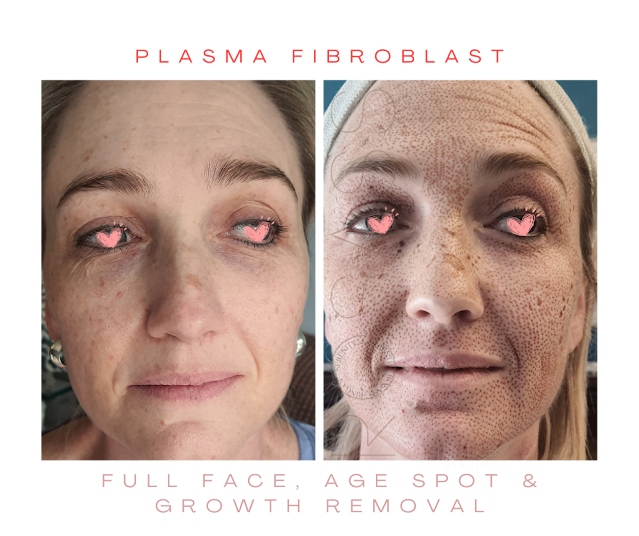 Plasma Fibroblast Before and Direct After Treatment