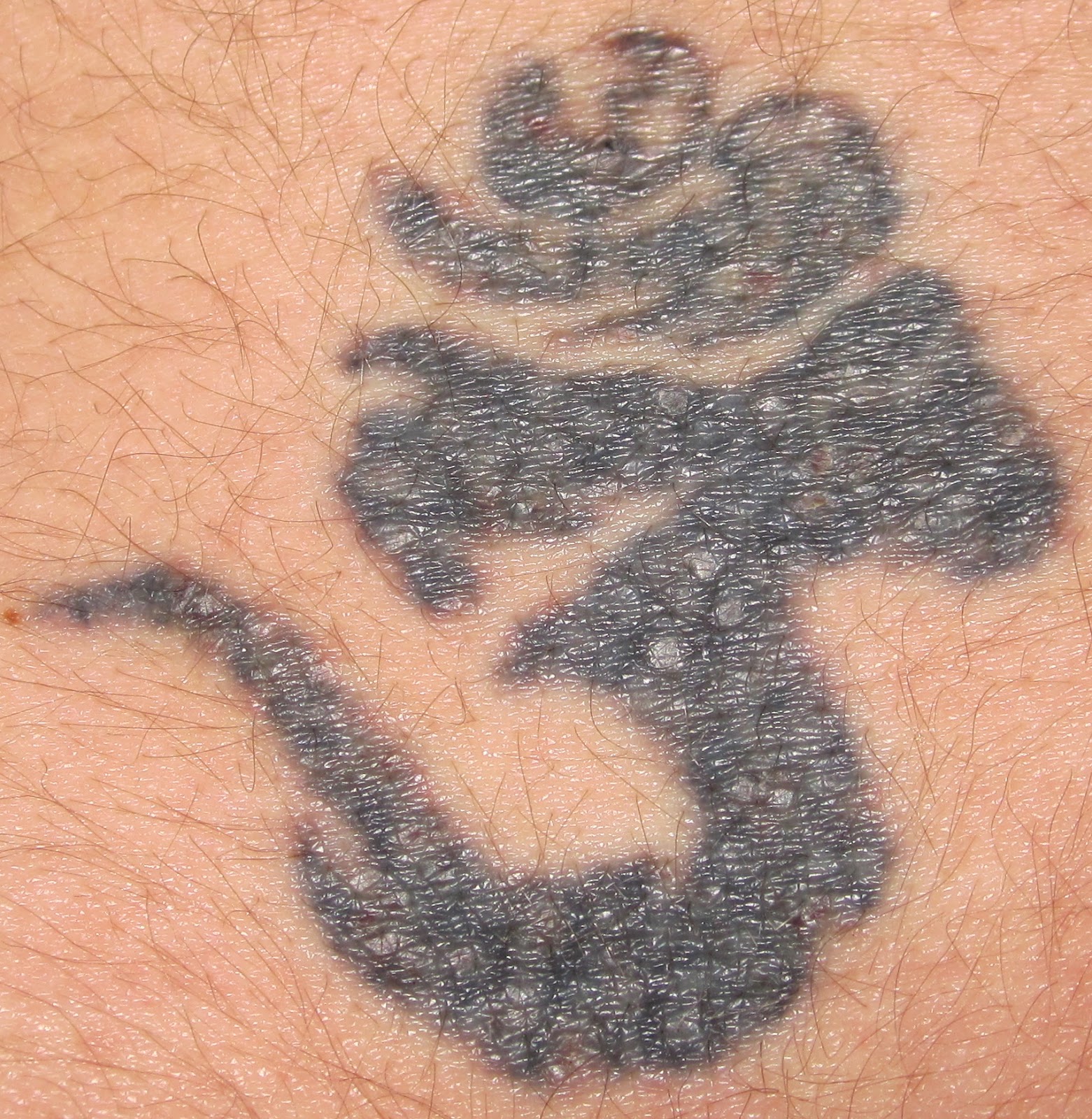 How Much Is Laser Tattoo Removal