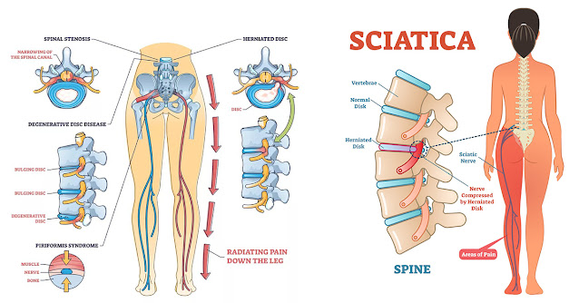 5 Exercises to Avoid If You Have Sciatica