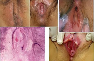 Penyakit Sipilis wanita