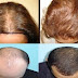 Do you have alopecia (Hair fall from the scalp) problem? Read this.