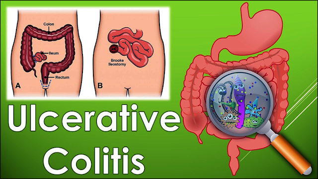  Ulcerative colitis natural remedies