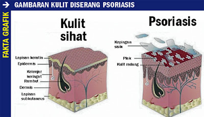 Penyakit kulit psoriasis - Sel kulit mati tidak sekata