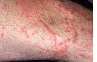 Rhus-Dermatitis