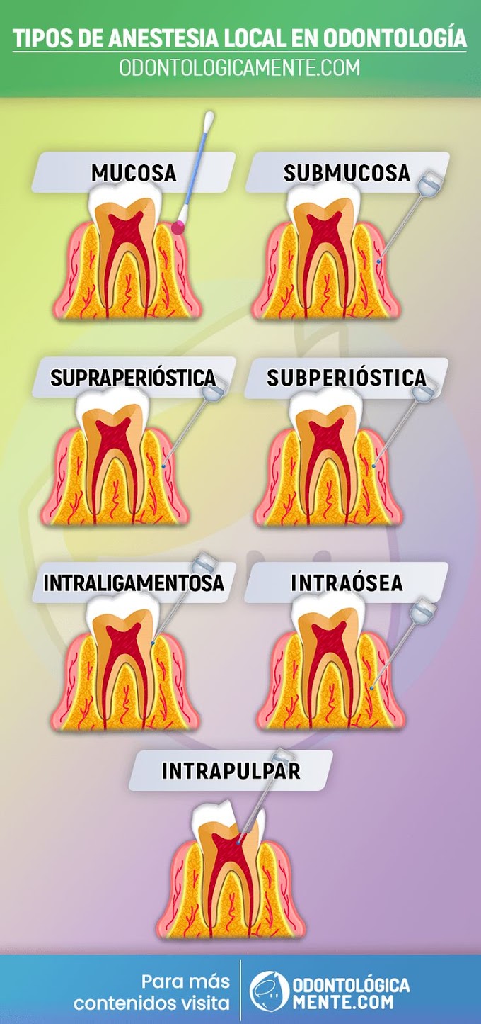 Tipos de anestesia local en odontología (Infografía)