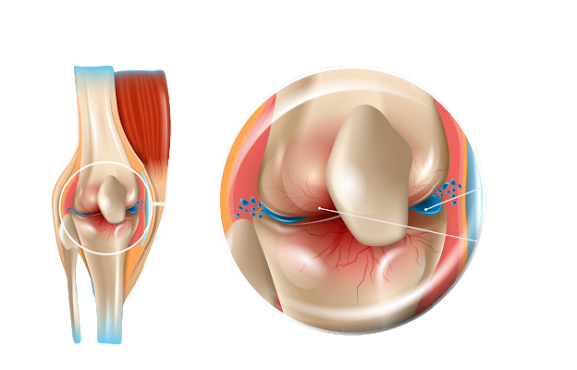 Osteoarthritis Drugs Market