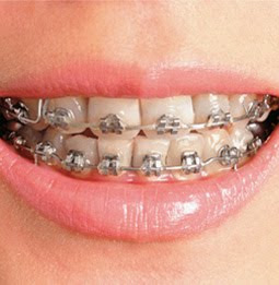 orthodontic-braces