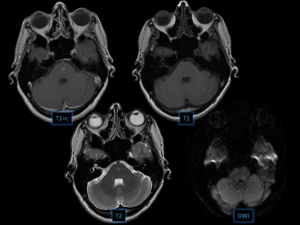 Brain capillary telangiectasia