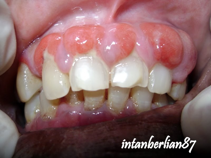 Multiple periodontal abscess in diabetic patient berserta 