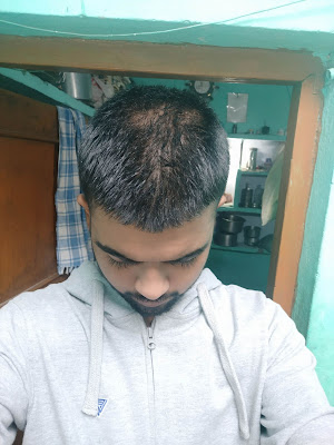 finasteride-results