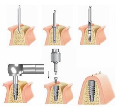 Thông tin về cấy ghép implant