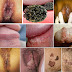 Cara Penularan Penyakit Genital Warts Kondiloma Akuminata