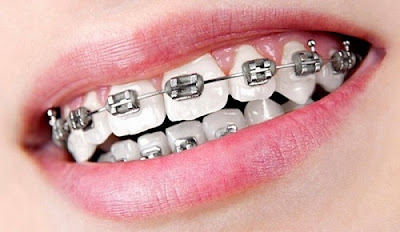 Quy trình niềng răng móm như thế nào hiệu quả? 2