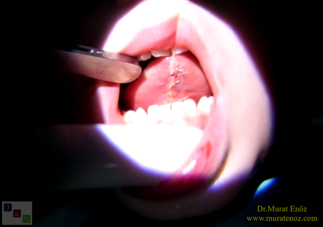 Dil bağı çıkarılması - Lingual frenektomi - Dil bağı tedavisi - Dil altı bağı kesilmesi - Dil bağı ameliyatı - Dil bağı operasyonu - Lingual frenectomy - Dil altı bağı tedavisi - Dil bağı çıkarılması işlemi fiyatı - Dil bağı çıkarılması işlemi nasıl yapılır? - Dil bağı çıkarılması (lingual frenektomi) nedir? - Kansız dil bağı ameliyatı – Thermal welding ile dil bağı ameliyatı -  Tongue tie release surgery with thermal welding device - Lingual frenectomy operation with thermal welding device - Bloodless and knifeless tongue tie release surgery - Bloodless lingual frenectomy with with thermal welding – Tongue tie treatment in İstanbul, Turkey