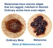 Waspadai Gejala MELANOMA Sejak Dini